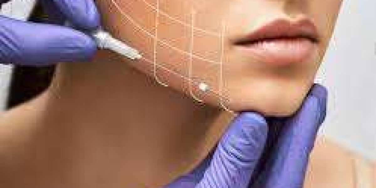 Face thread uplift in islamabad
