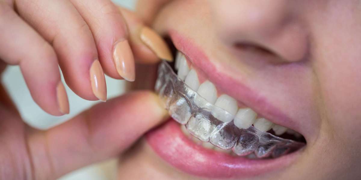 Invisalign vs Braces: A Complete Comparison Guide